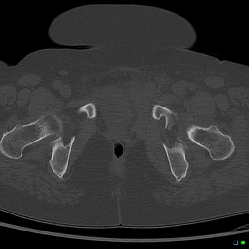 File:Central fracture-dislocation of the acetabulum (Radiopaedia 36578-38150 Axial bone window 73).jpg