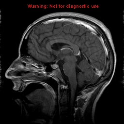 File:Central nervous system vasculitis (Radiopaedia 8410-9235 Sagittal T1 C+ 12).jpg