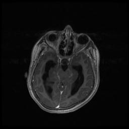 Central neurocytoma (Radiopaedia 30220-30842 Axial T1 C+ 57).jpg