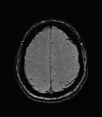 File:Central neurocytoma (Radiopaedia 71068-81303 Axial SWI 53).jpg