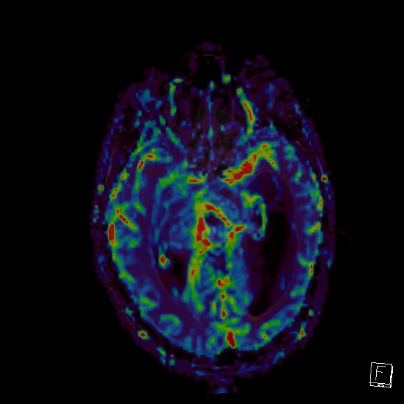 Central neurocytoma (Radiopaedia 84497-99872 Axial Perfusion 185).jpg