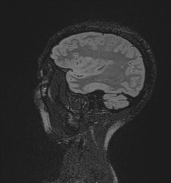 Central neurocytoma (Radiopaedia 84497-99872 Sagittal Flair + Gd 40).jpg