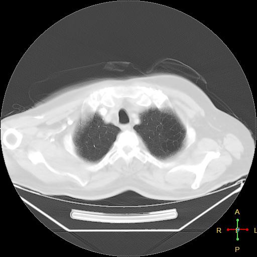 File:Centrilobular emphysema - with superimposed infection (Radiopaedia 24389-24683 lung window 3).jpg