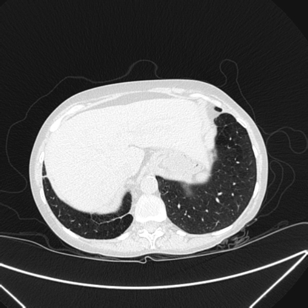 Centrilobular pulmonary emphysema (Radiopaedia 24495-24789 Axial lung window 82).jpg
