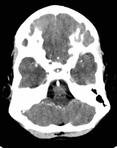 Cerebellar abscess (Radiopaedia 73727-84527 Axial C+ 18).jpg