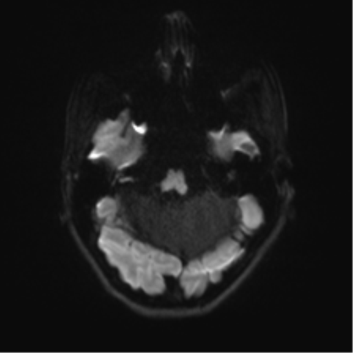 Cerebellar agenesis with hypoplastic pons (pontocerebellar hypoplasia) (Radiopaedia 57224-64138 Axial DWI 47).png