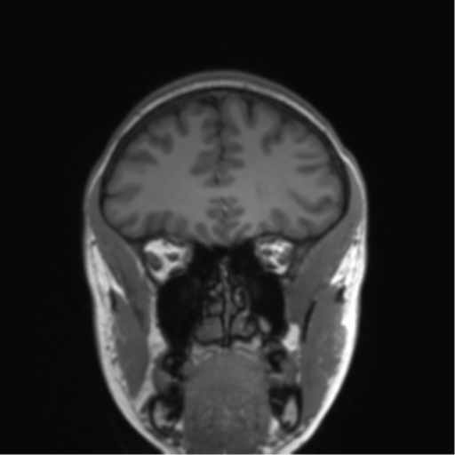Cerebellar agenesis with hypoplastic pons (pontocerebellar hypoplasia) (Radiopaedia 57224-64138 Coronal T1 69).png