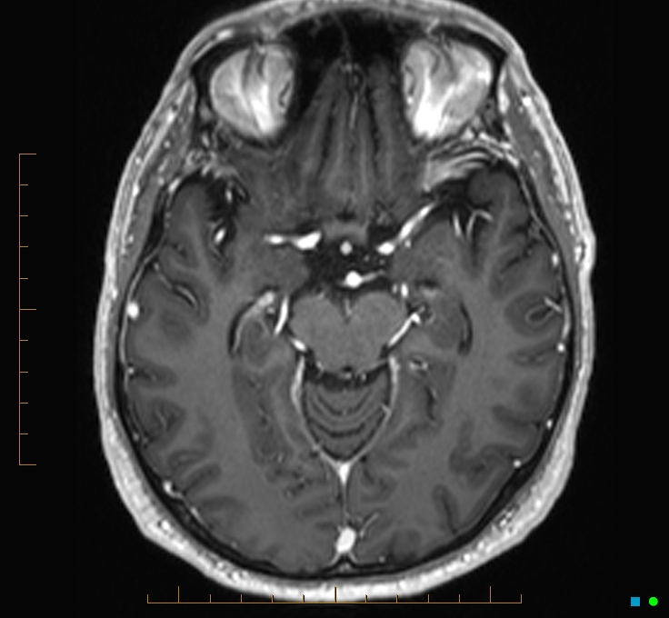 Cerebellar gangliocytoma (Radiopaedia 65377-74422 Axial T1 C+ 50).jpg