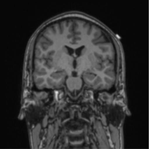 Cerebellar hemangioblastomas and pituitary adenoma (Radiopaedia 85490-101176 Coronal T1 50).png