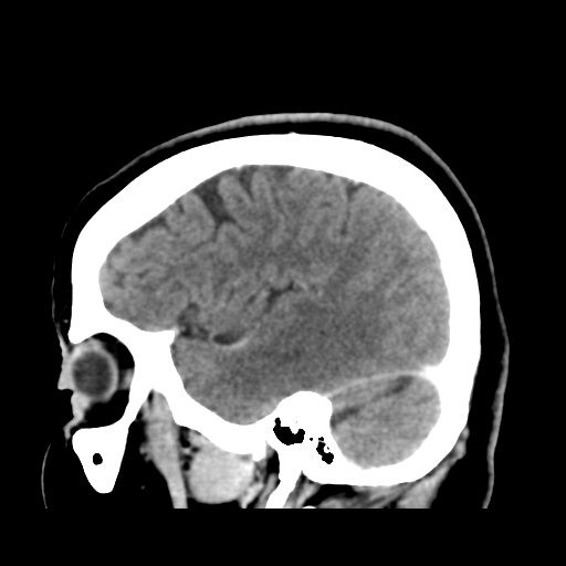 File:Cerebellar metastasis (cystic appearance) (Radiopaedia 41395-44258 F 14).png