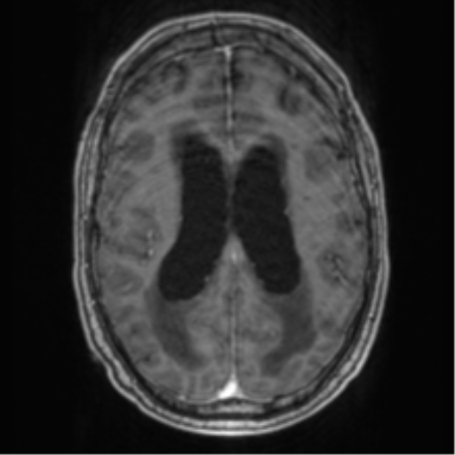 Cerebellar metastasis from lung adenocarcinoma (Radiopaedia 86690-102829 Axial T1 C+ 51).png
