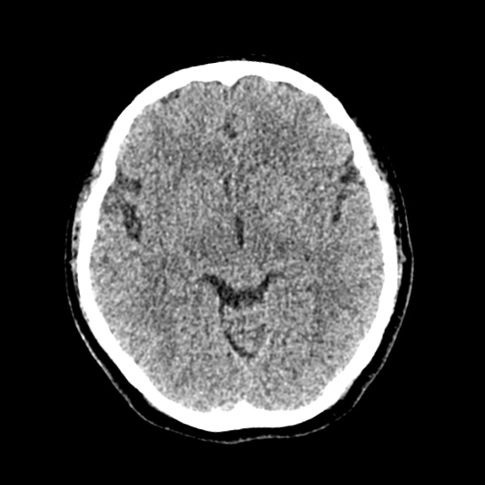 Cerebellopontine angle meningioma (Radiopaedia 53561-59592 Axial non-contrast 31).jpg
