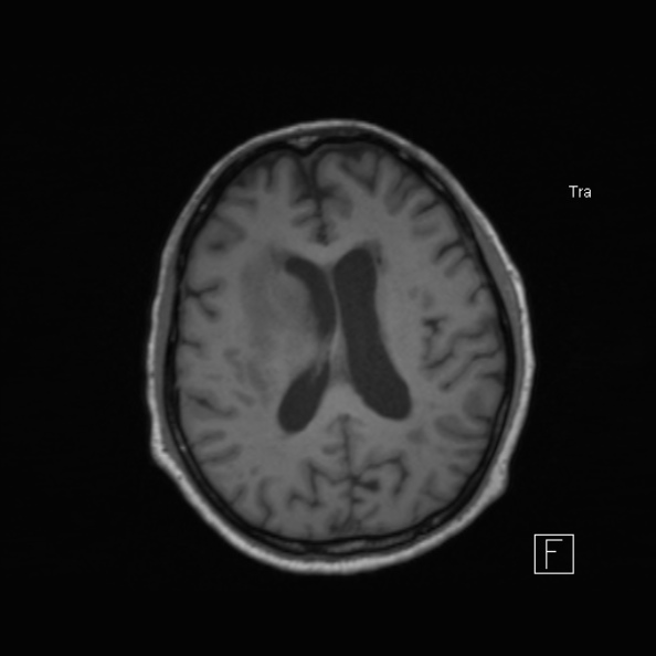 Cerebral abscess (Radiopaedia 26111-26247 Axial T1 37).jpg