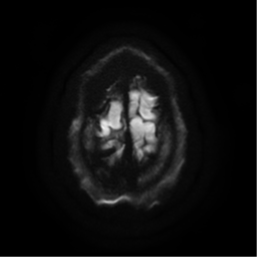 Cerebral abscess (Radiopaedia 57774-64740 Axial DWI 27).png
