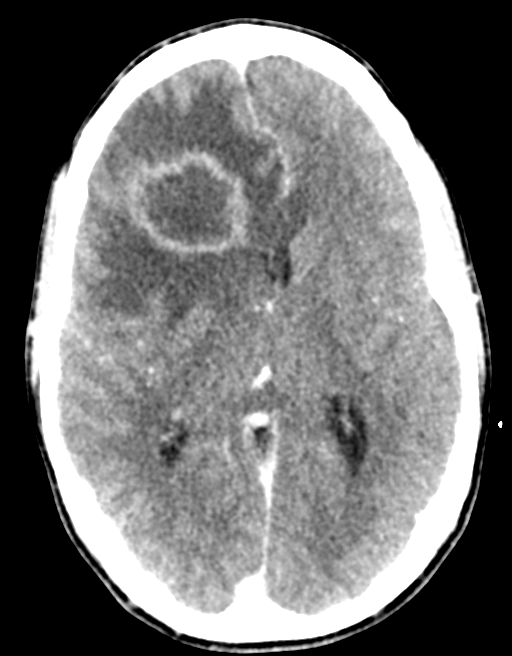 Cerebral abscess (Radiopaedia 60342-68008 Axial C+ delayed 27).png