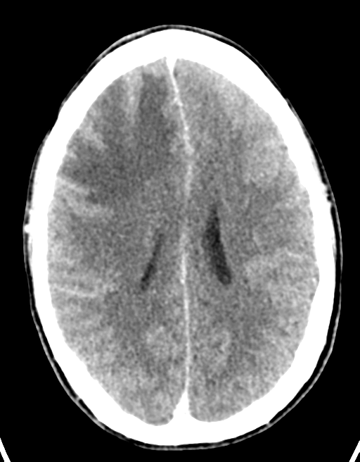 Cerebral abscess (Radiopaedia 60342-68008 Axial C+ delayed 33).png