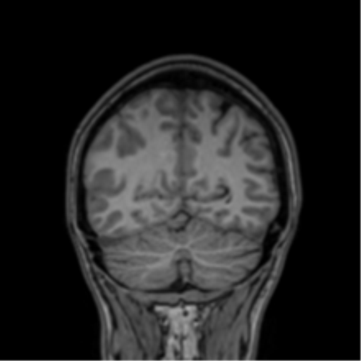 Cerebral abscess (Radiopaedia 60342-68009 Coronal T1 8).png