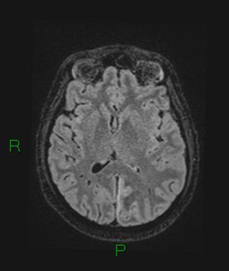 Cerebral abscess and subdural empyema (Radiopaedia 84436-99779 Axial FLAIR 41).jpg