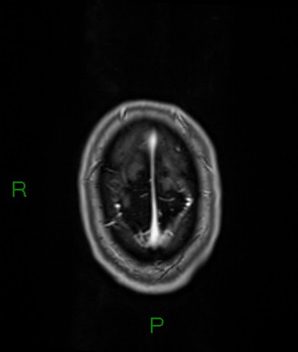 Cerebral abscess and subdural empyema (Radiopaedia 84436-99779 Axial T1 C+ 11).jpg