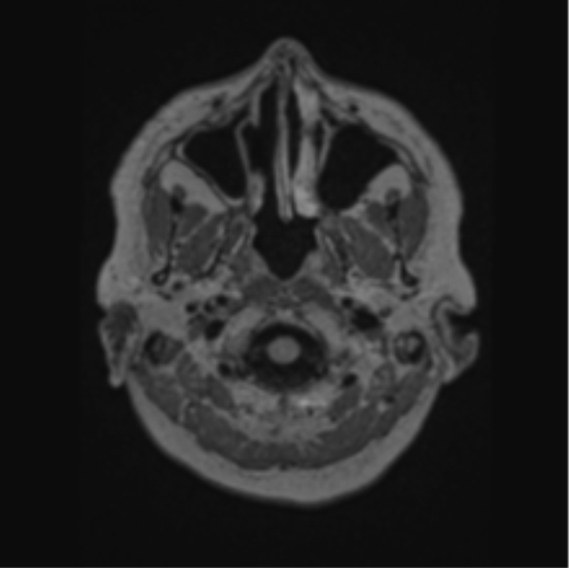 Cerebral abscess from pulmonary arteriovenous malformation (Radiopaedia 86275-102291 J 8).png