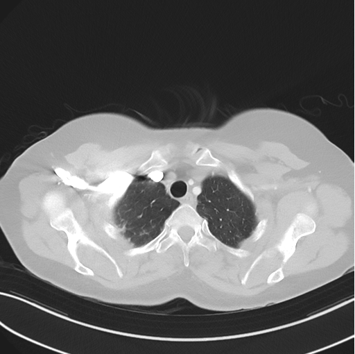 Cerebral abscess from pulmonary arteriovenous malformation (Radiopaedia 86275-102292 Axial lung window 12).png