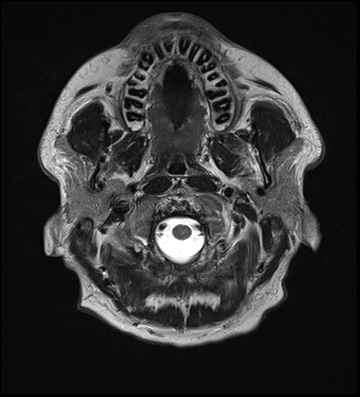 File:Cerebral abscess with ventriculitis (Radiopaedia 78965-91878 Axial T2 3).jpg