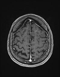 Cerebral amyloid angiopathy-related inflammation (Radiopaedia 58270-65377 Axial T1 C+ fat sat 119).jpg