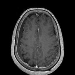 File:Cerebral amyloid angiopathy (Radiopaedia 29129-29518 Axial T1 C+ 107).jpg