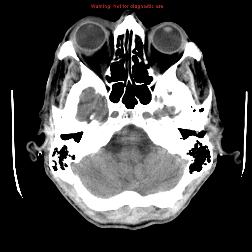 File:Cerebral and orbital tuberculomas (Radiopaedia 13308-13310 Axial non-contrast 6).jpg