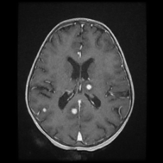 Cerebral and spinal tuberculosis (Radiopaedia 90489-107837 Axial T1 C+ 118).jpg