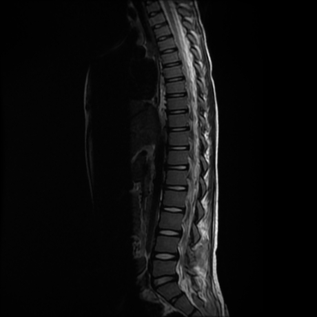File:Cerebral and spinal tuberculosis (Radiopaedia 90489-107912 Sagittal T2 5).jpg