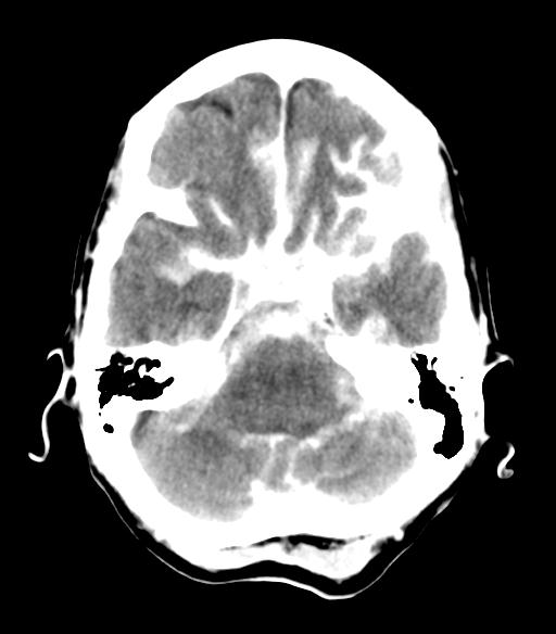File:Cerebral aneurysm with rupture (Radiopaedia 29933-30460 Axial non-contrast 7).jpg