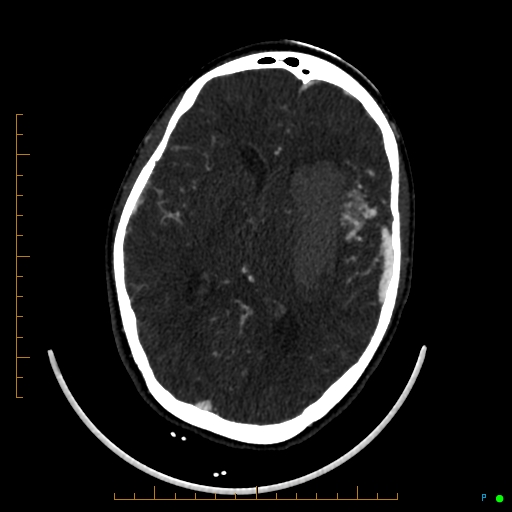 Cerebral arteriovenous malformation (AVM) (Radiopaedia 78162-90706 Axial CTA 150).jpg