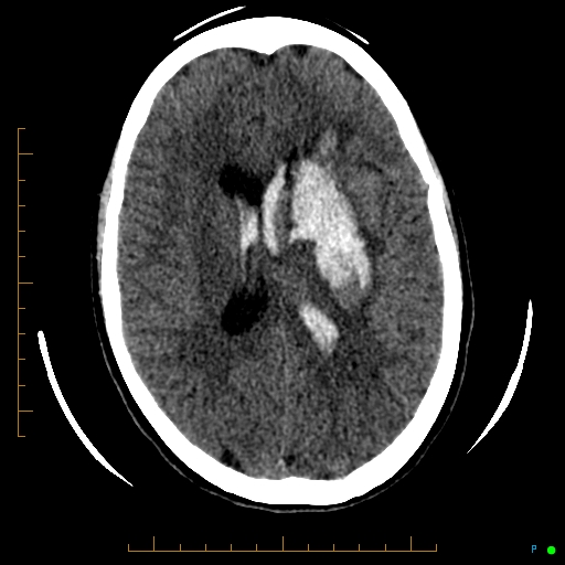 Cerebral arteriovenous malformation (AVM) (Radiopaedia 78162-90706 Axial non-contrast 39).jpg