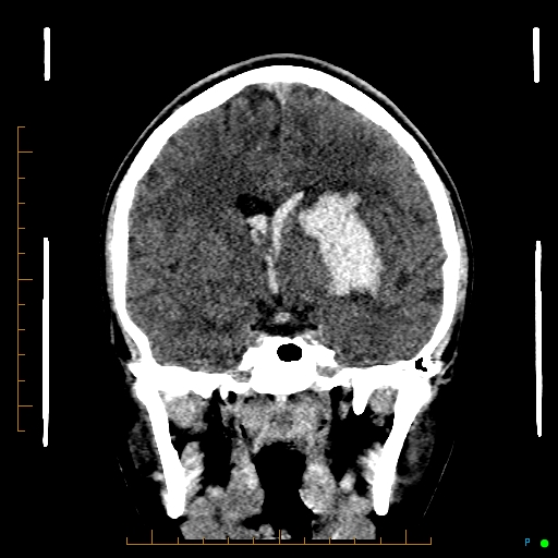 Cerebral arteriovenous malformation (AVM) (Radiopaedia 78162-90706 Coronal non-contrast 47).jpg