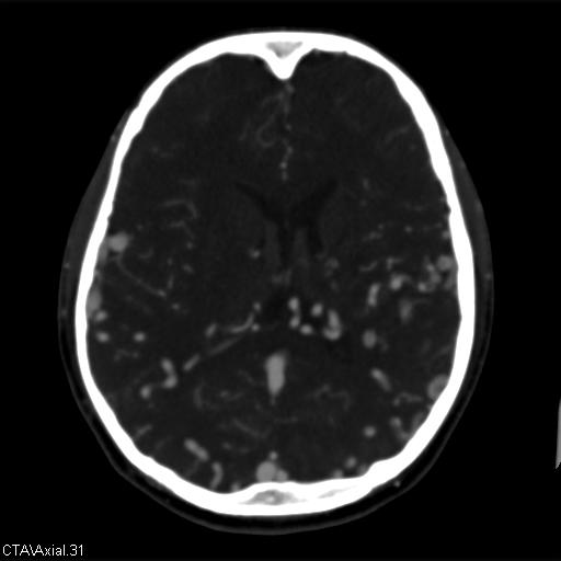 File:Cerebral arteriovenous malformation (Radiopaedia 28518-28759 B 31).jpg