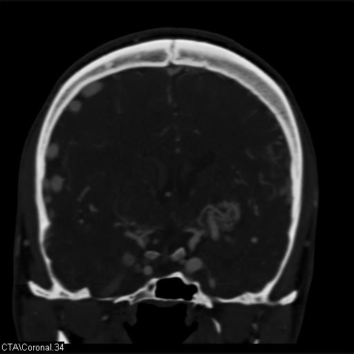 Cerebral arteriovenous malformation (Radiopaedia 28518-28759 C 34).jpg