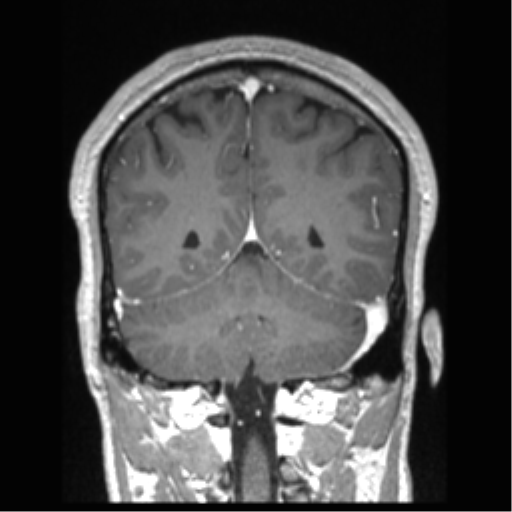 Cerebral arteriovenous malformation (Radiopaedia 39259-41506 Coronal T1 C+ 30).png