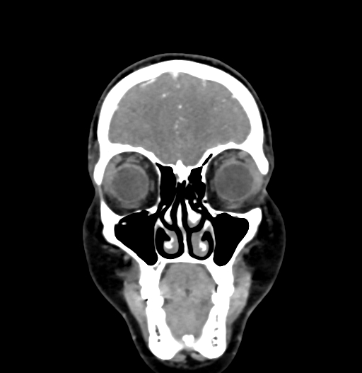 Cerebral arteriovenous malformation (Radiopaedia 73830-84645 C 16).jpg