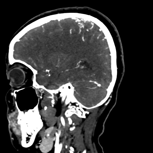 Cerebral arteriovenous malformation (Radiopaedia 73830-84645 Sagittal C+ delayed 64).jpg