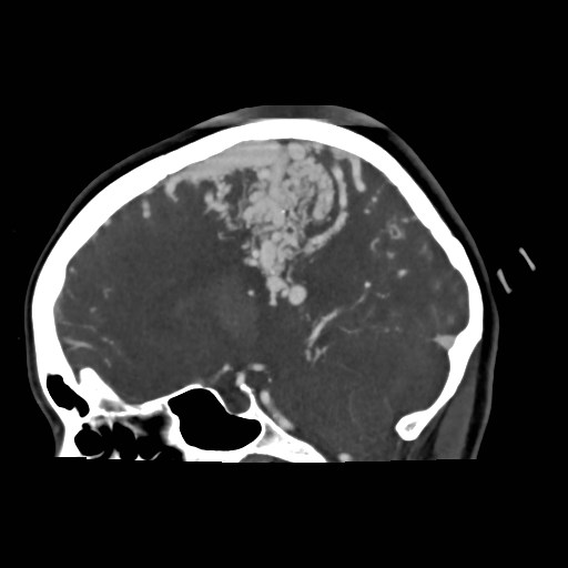 File:Cerebral arteriovenous malformation (Radiopaedia 79677-92888 C 18).jpg