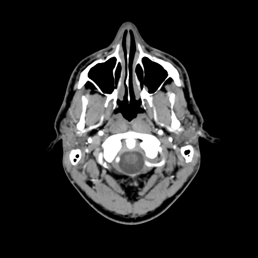 Cerebral arteriovenous malformation (Spetzler-Martin grade 2) (Radiopaedia 41262-44076 Axial C+ 2).png