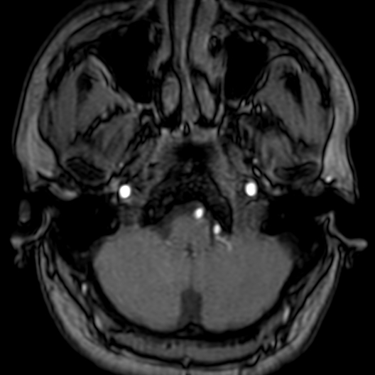 Cerebral arteriovenous malformation at posterior body of corpus callosum (Radiopaedia 74111-84925 Axial MRA 19).jpg