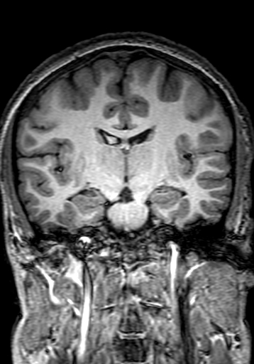 Cerebral arteriovenous malformation at posterior body of corpus callosum (Radiopaedia 74111-84925 Coronal T1 166).jpg
