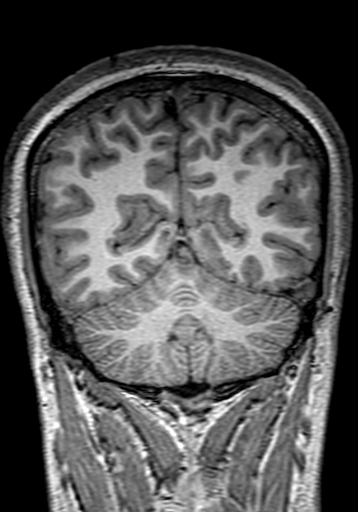 File:Cerebral arteriovenous malformation at posterior body of corpus callosum (Radiopaedia 74111-84925 Coronal T1 264).jpg