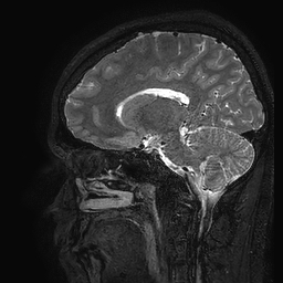 Cerebral arteriovenous malformation at posterior body of corpus callosum (Radiopaedia 74111-84925 Sagittal T2 52).jpg