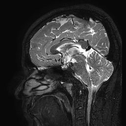 Cerebral arteriovenous malformation at posterior body of corpus callosum (Radiopaedia 74111-84925 Sagittal T2 66).jpg