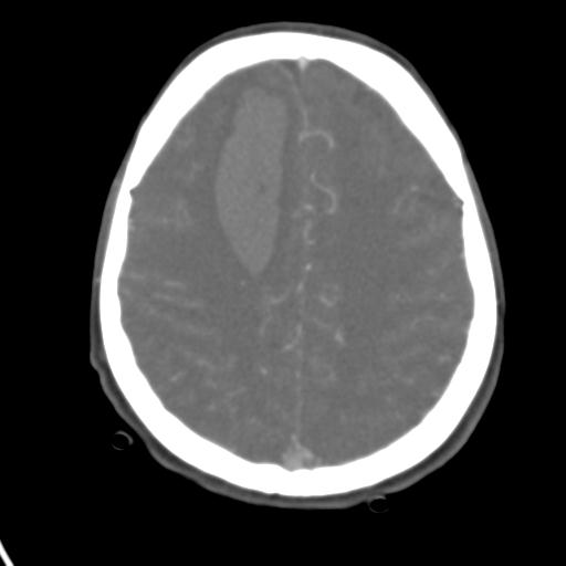 Cerebral arteriovenous malformation with hemorrhage (Radiopaedia 28773-29073 A 17).jpg