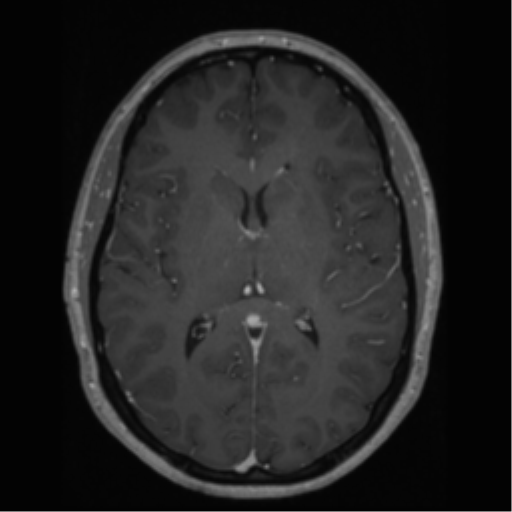 Cerebral cavernoma and development venous anomaly (Radiopaedia 37603-39482 Axial T1 C+ 41).png