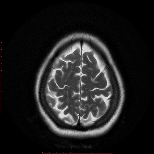 File:Cerebral cavernous malformation (Radiopaedia 26177-26306 Axial T2 18).jpg